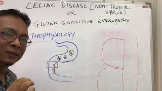 celiac diseasenon tropical spruepathophysiology [upl. by Caddric]