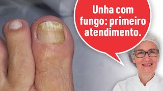 UNHA COM FUNGO PRIMEIRO ATENDIMENTO [upl. by Theola]