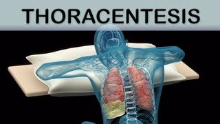 Thoracentesis Medical Animation [upl. by Aicilic]