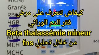 كيفاش تتعرف على مرض فقر الدم الوراثي beta thalassémie mineur من تحليل fns [upl. by Eladnyl496]