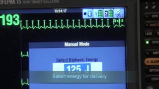 Synchronized Cardioversion [upl. by Wilmette]