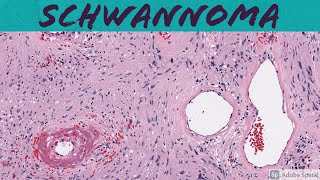 Schwannoma 5Minute Pathology Pearls [upl. by Dupuy594]