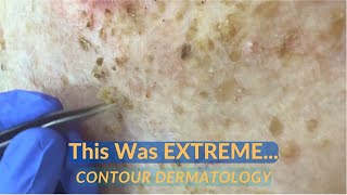 SEVERE Debridement of Seborrheic Dermatitis Scale  CONTOUR DERMATOLOGY [upl. by Shelly]