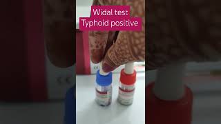 widal test positive typhoid positive case clumping salmonella typhoid ytshortsindia must watch [upl. by Leirbaj]