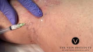 More Sclerotherapy Treatment for Spider Veins [upl. by Germayne]