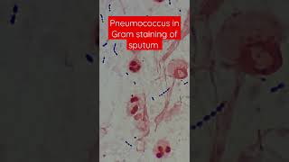 Pneumonia causing Bacteria in Sputum Pneumococcus Gram positive dipococci [upl. by Nemajneb5]