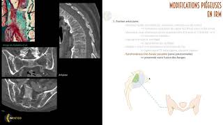 TUTORIEL IMOSTEO 14 IRM des sacroiliaques Modifications pièges [upl. by Dinnage369]