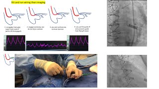 Aortoostial angiography and stenting tips and tricks  case illustrations Elias Hanna [upl. by Gertruda]