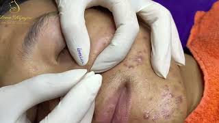 Loan Nguyen Acne Treatment 50b [upl. by Acihsay]