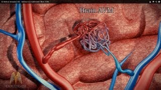 3D Medical Animation HD  Arteriovenous Malformation Brain AVM [upl. by Melita]