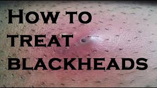 How to treat blackheads [upl. by Dolli]