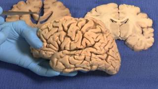 Limbic Neuroanatomy Video Lab  Brain Dissections [upl. by Lucias]