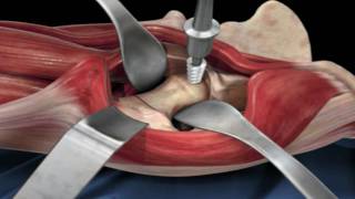 Direct Anterior Approach Hip Replacement [upl. by Branden]