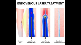 Operația de varice cu laser și recidiva  Varicele reapar dupa operatie Stefan Jianu  ProEstetica [upl. by Enialahs]