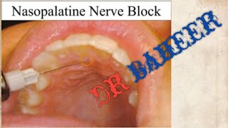 nasopalatine nerve block [upl. by Latt]