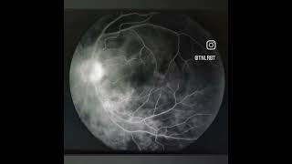 Fundus Fluorescein Angiography of APMPPE MEWDS angiography eye ffa [upl. by Thetis45]