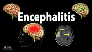 Encephalitis Animation [upl. by Lanuk]