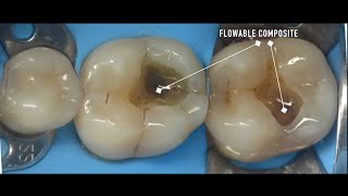 Composite vs Amalgam [upl. by Giarc949]