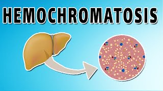 Hemochromatosis [upl. by Charters805]