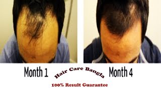 Homeopathic Medicine For Alopecia and Baldness  Hair Care Bangla [upl. by Etnemelc]