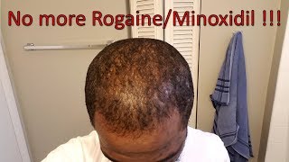 No more rogaineMinoxidil  Week1 [upl. by Jereme]