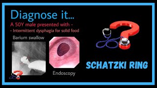 50 Y male with dysphagia  Schatzki Ring [upl. by Reerg196]