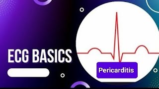 ECG Basics  ECG Changes in Pericarditis  Benign Early Repolarization Vs Pericarditis [upl. by Sair]