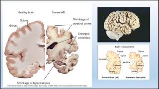 Neurological Disorders [upl. by Belldame]