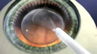 Staar Surgical Visian ICL Implantation [upl. by Mikah390]