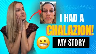 CHALAZION Symptoms Treatment Risk Factors Recovery My Story [upl. by Bergstein972]