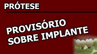 Confecção de provisório sobre implante HE [upl. by Lagas]