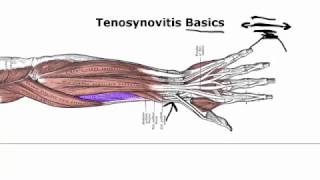 Tenosynovitis Basics Your Doctor Doesnt Tell You [upl. by Hgielanna779]