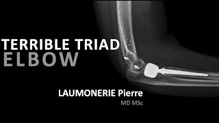 Terrible triad injury of the elbow  Terrible triade du coude  par le Dr Laumonerie [upl. by Eissel202]