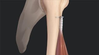 Biceps Tenotomy vs Tenodesis Literature Review and Rationale for Tenodesis [upl. by Nowell]