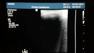 Hepatic Hydatid Cyst Ultrasound [upl. by Mundford]