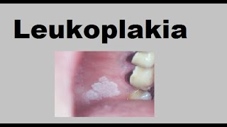 Leukoplakia [upl. by Arrimat]