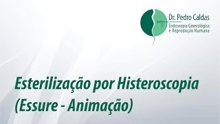 Esterilização por Histeroscopia  Essure® animação [upl. by Etselec]