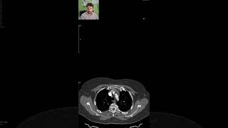 PAIN and MISSING PULSE in the left arm  CT SCANS Ep 15 ctscan medicalimaging angiography [upl. by Ulani]