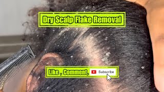 Dry scalp Flake removal [upl. by Lebiralc]