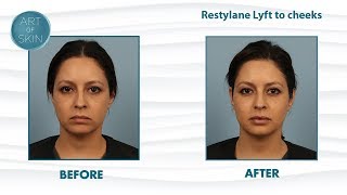 Restylane Lyft Perlane filler for cheek lifting and facial balancing [upl. by Aletta]