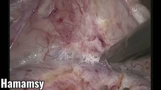 Hamamsy cervical myoma tips and tricks [upl. by Asilat714]