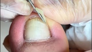 Repair mild ingrown toenails [upl. by Nealson335]