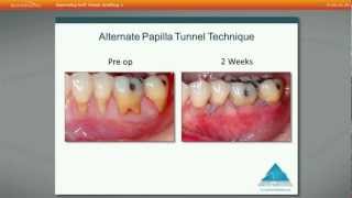 Improve your success with soft tissue grafting using acellular dermal matrix by Dr Edward P Allen [upl. by Keyser]