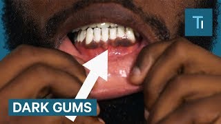 Why Some People Have Black Gums [upl. by Adiaj]