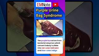 Purple Urine Bag Syndrome nursing doctor medical [upl. by Jaylene]