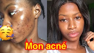 Comment se débarrasser de l’acné bouton et des points noirs sur le visage [upl. by Ange]