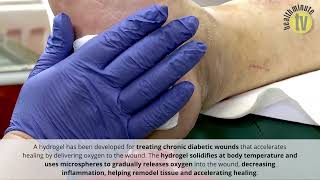 Hydrogel developed for accelerated diabetic wound healing [upl. by Cornew]