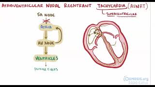 Atrioventricular Nodal Reentrant Tachycardia  Osmosis [upl. by Yirinec]