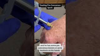 Actinic Keratosisprecancerous spot removal dermatology skin skincancer skincancerprevention [upl. by Maura321]