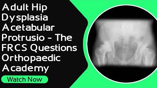 Adult Hip Dysplasia  Acetabular Protrusio  The FRCS Questions। Orthopaedic Academy [upl. by Lehsar]